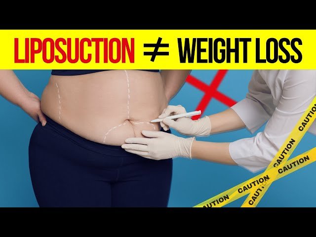 Is Liposuction a Good Option for Weight Loss?