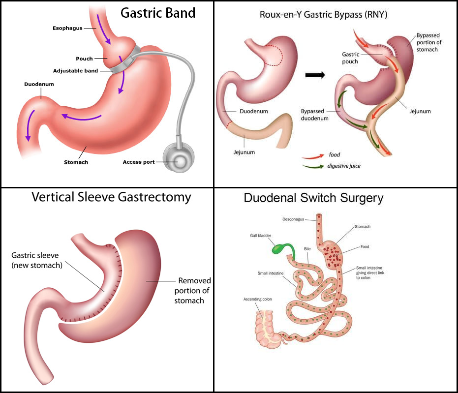 What is Bariatric Surgery for Weight Loss?